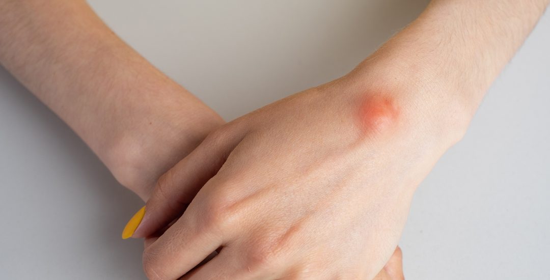 Essential Guide to Skin Lesions, Masses, and Cysts for Better Skin Health