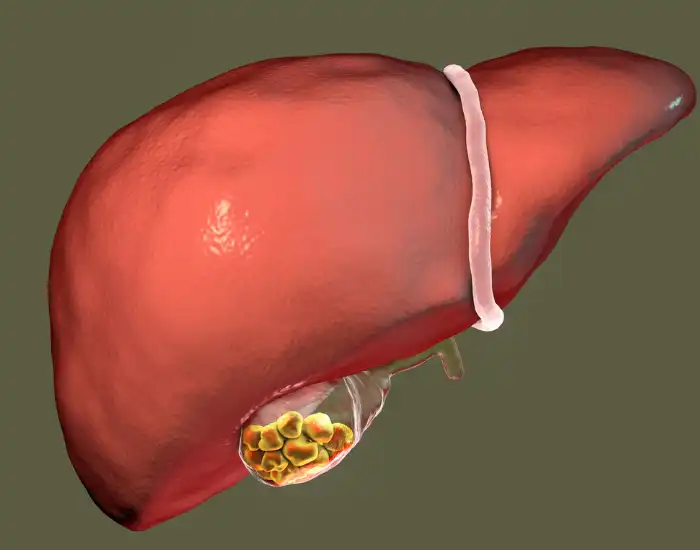 Do Gallstones Always Need Surgery? Treatment Options Explained