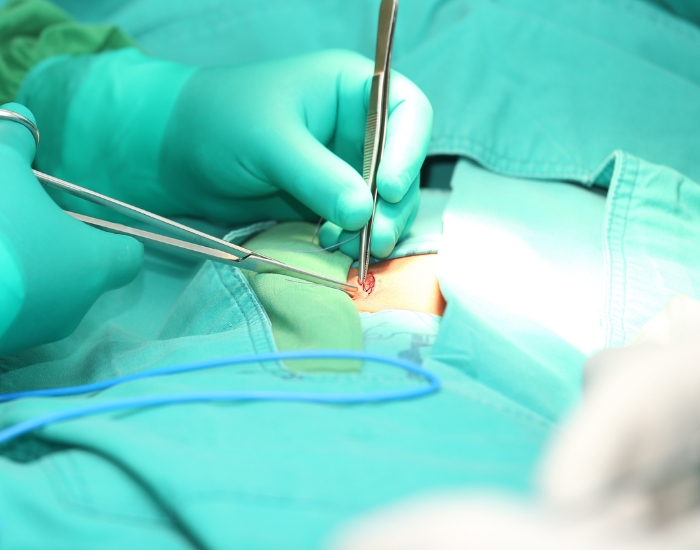 Hernia Repair Recovery Timeline in Texas