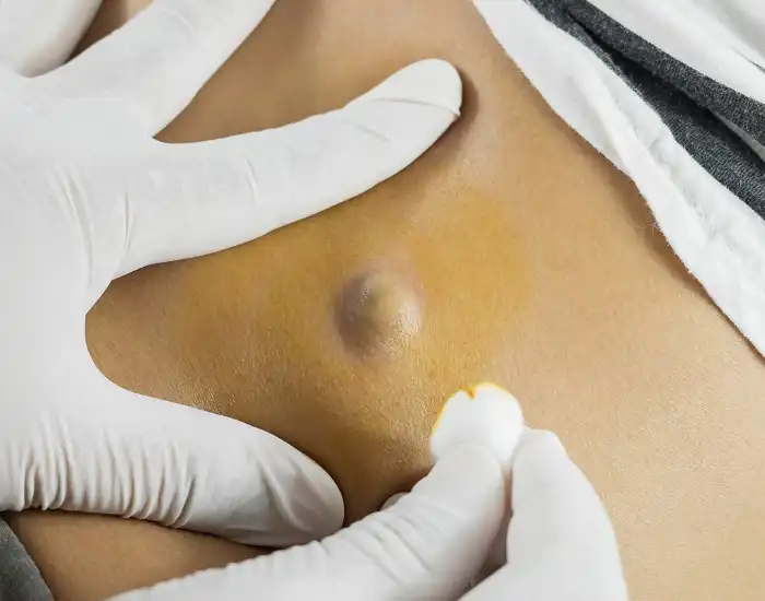 Signs of Infected Sebaceous Cyst: Symptoms, Risk Factors, and Treatment
