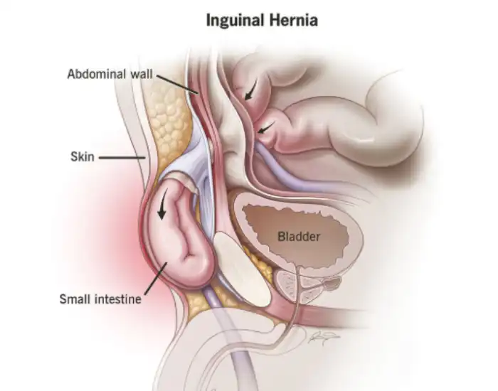 Inguinal Hernia Symptoms, Pain & Surgery Recovery