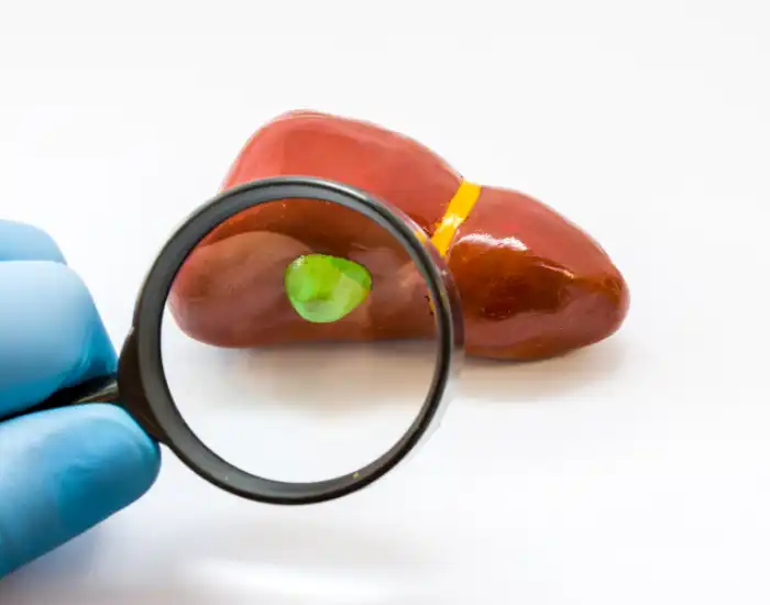 Post Cholecystectomy Syndrome: Causes & Symptoms