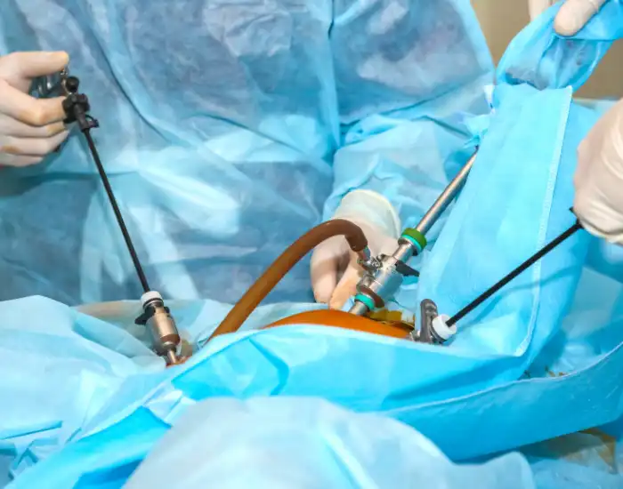 Laparoscopic instruments placed through small abdominal incisions during surgery