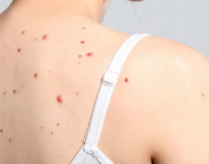 Skin lesions, masses and cysts