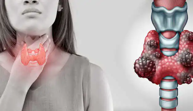 Thyroid and parathyroid cancer
