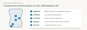Simplified torso showing five common hernia locations: epigastric, umbilical, incisional, inguinal, and femoral