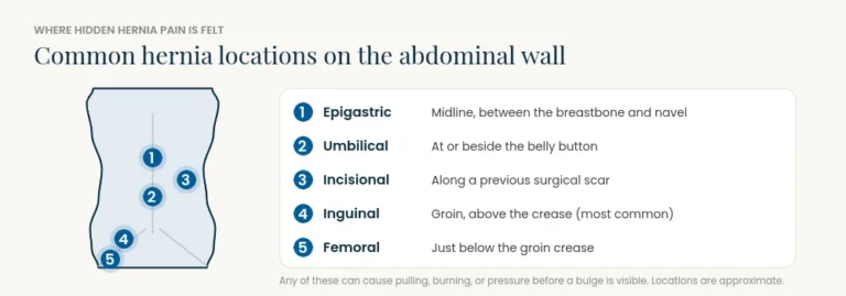 Simplified torso showing five common hernia locations: epigastric, umbilical, incisional, inguinal, and femoral