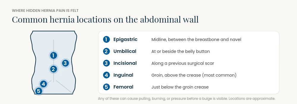 Simplified torso showing five common hernia locations: epigastric, umbilical, incisional, inguinal, and femoral